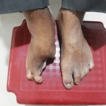 Insole-for-partial-foot-amputation-150x150 Insole-for-partial-foot-amputation-150x150