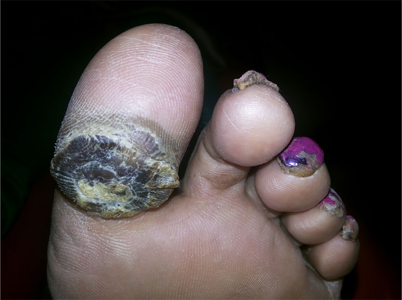 Callosity-2-Before-scraping1