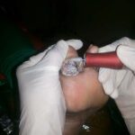 Non-surgical Debridement