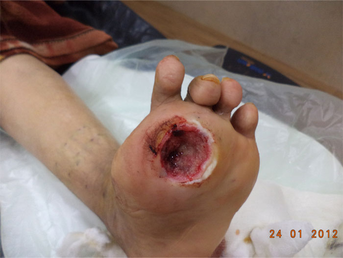 Diabetic-Foot-Ulcer