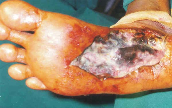 Diabetic foot wound