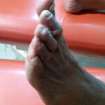 Hammer-toes-1-1