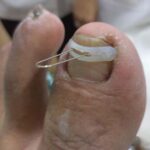 In-growing-Toe-Nail-1-2