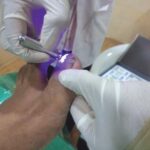 Ingrowing-Toe-nail-5