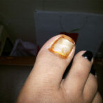 Ingrowing-toe-nails1