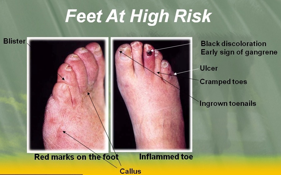 feet-at-risk