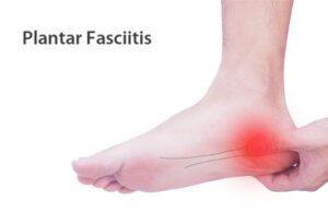 plantar-fasciitis
