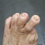 After Treatment 1 After Treatment 1