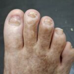 After Treatment 2 After Treatment 2